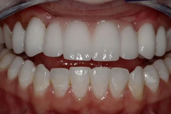 Bone grafting, implants and a bridge: after treatment, a patient of Nordhus Dentistry.