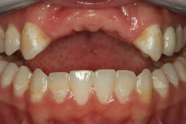 Bone grafting, implants and a bridge: before treatment, a patient of Nordhus Dentistry.
