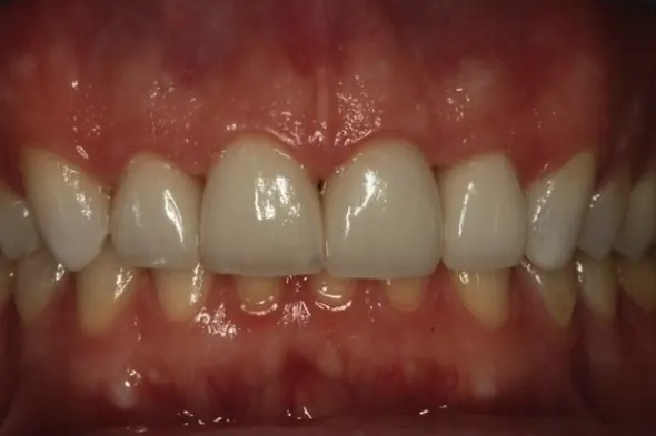 Invisalign&reg;: after treatment, a patient of Nordhus Dentistry.