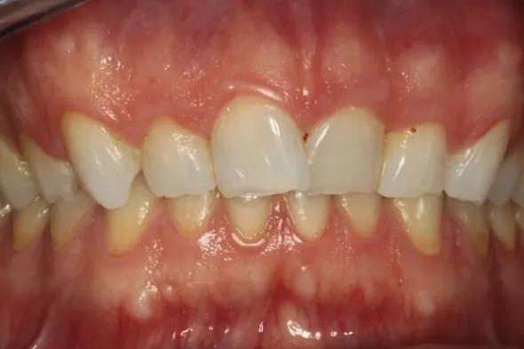 Invisalign&reg;: before treatment, a patient of Nordhus Dentistry.