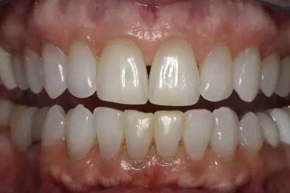 Invisalign&reg;: after treatment, a patient of Nordhus Dentistry.