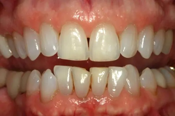 Invisalign®: before treatment, a patient of Nordhus Dentistry.