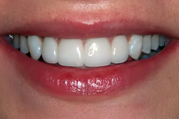 Porcelain veneers: after treatment, a patient of Nordhus Dentistry.