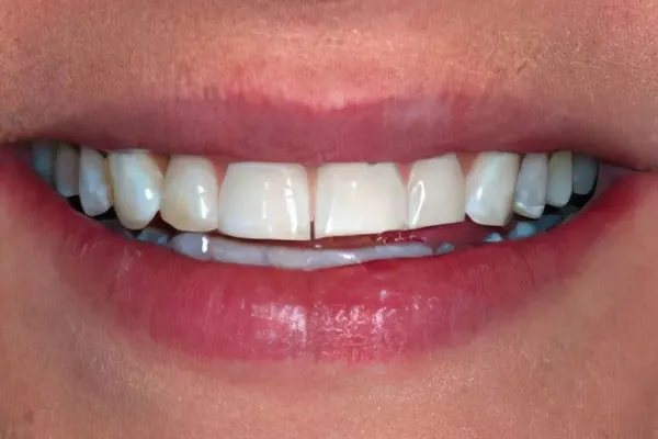 Porcelain veneers: before treatment, a patient of Nordhus Dentistry.