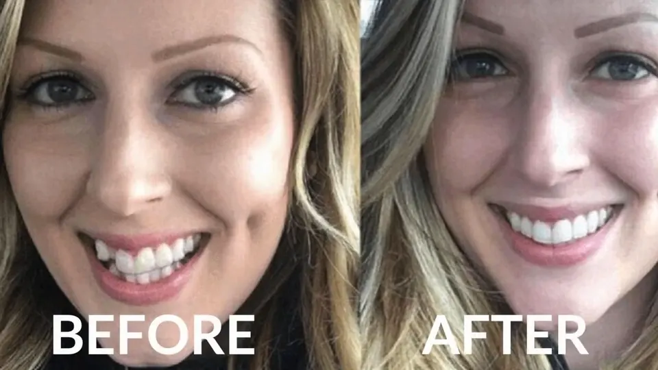 Poster frame from the practice&rsquo;s video &ldquo;Straighter Teeth without Braces&rdquo;.